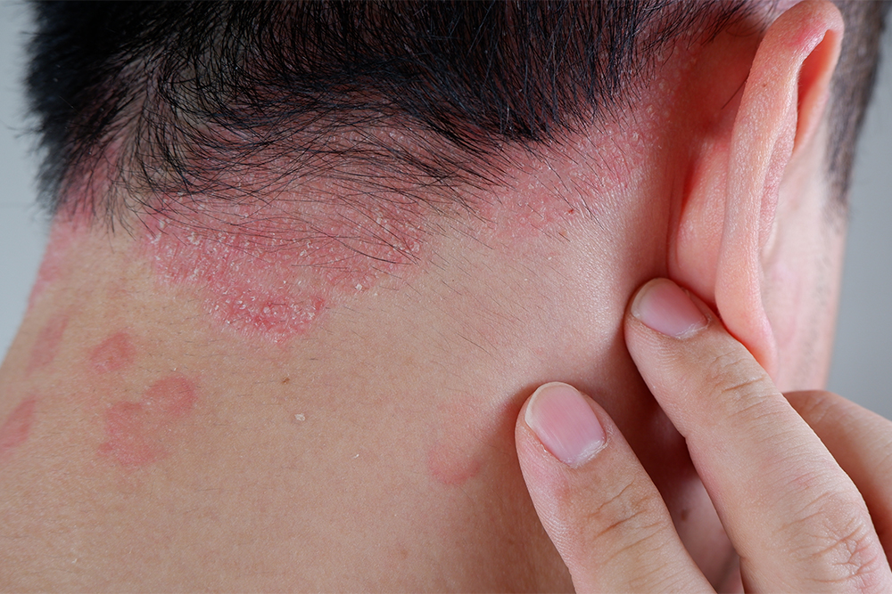 Всемирный день борьбы с псориазом