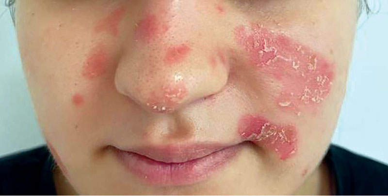 Всемирный день борьбы с псориазом